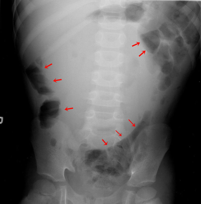 Duplication Cyst