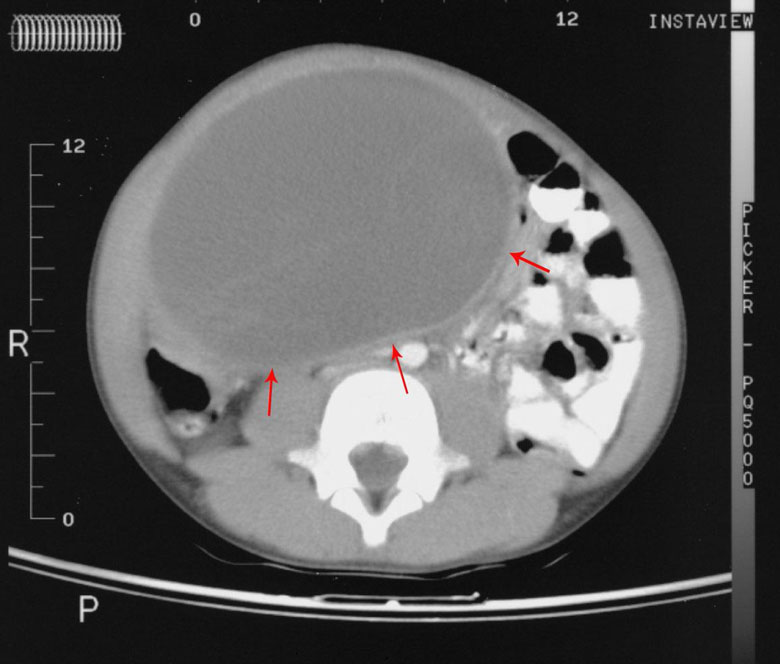 Duplication Cyst