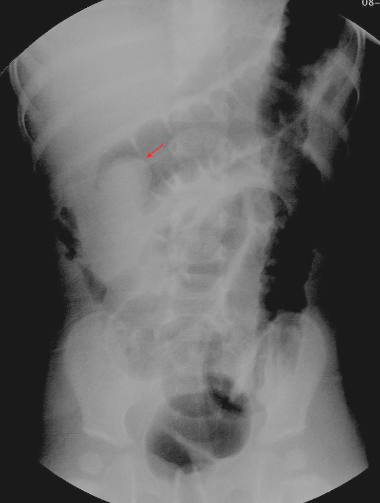 Intussusception