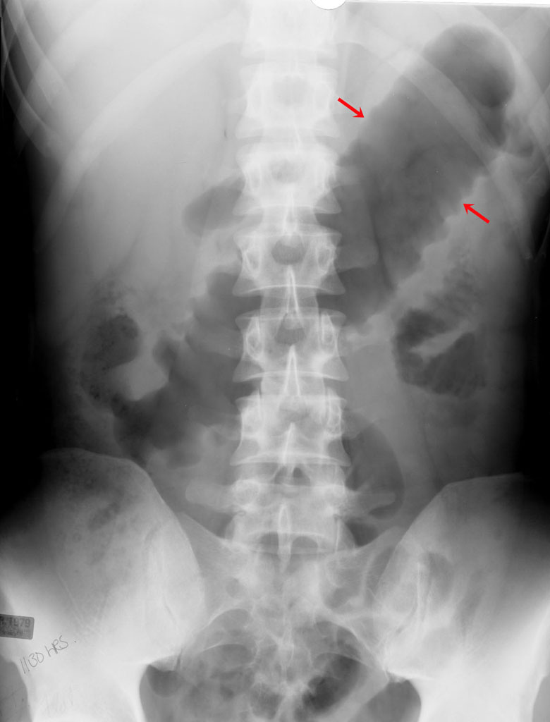 Toxic Megacolon
