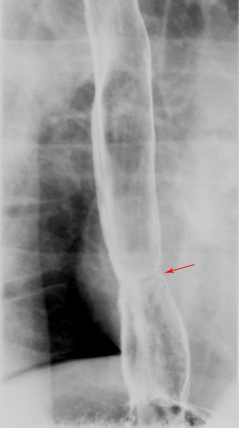 Barretts Esophagus