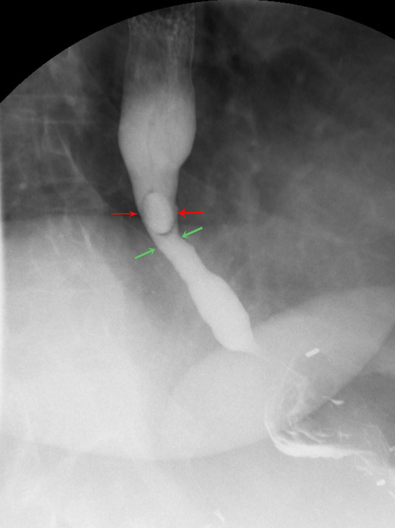 Esophageal Stricture