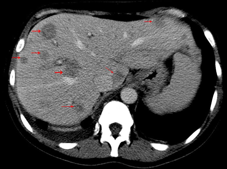 Fungal Abscess