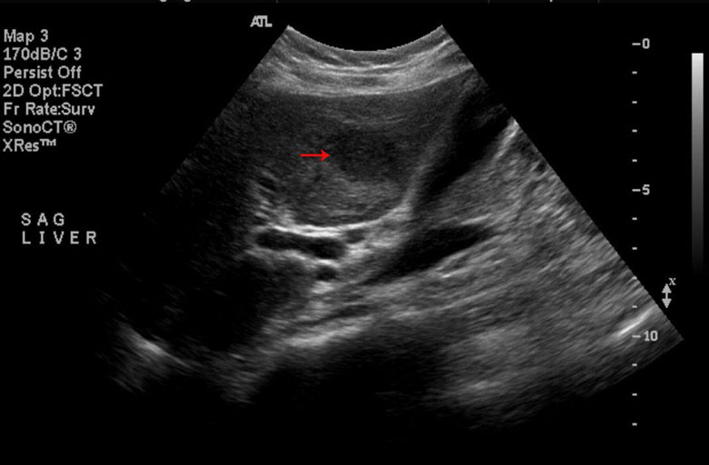 Fungal Abscess