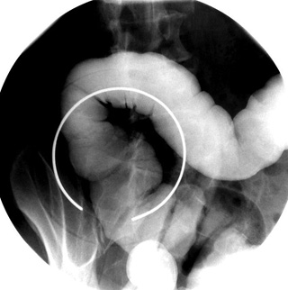 BE Hepatic Flexure spot