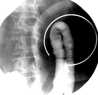 BE Splenic Flexure spot