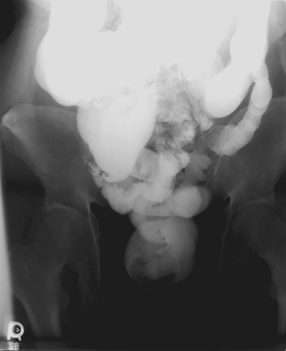 BE Angle Rectum overhead