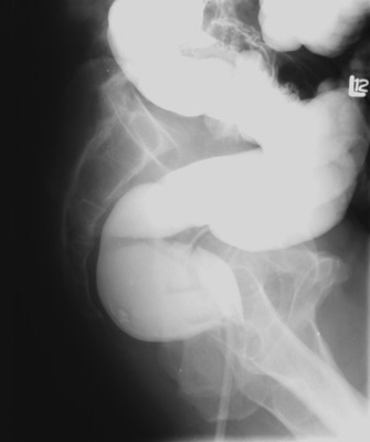 BE lateral rectum overhead