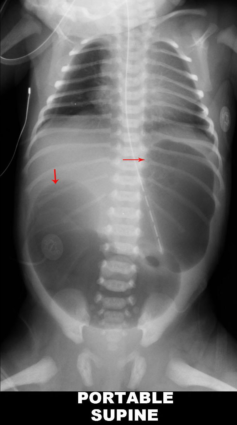 Double Bubble Atresia