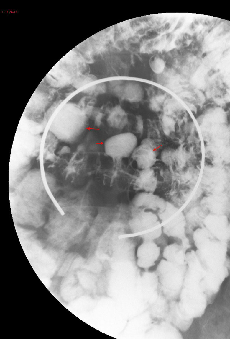 Diverticula