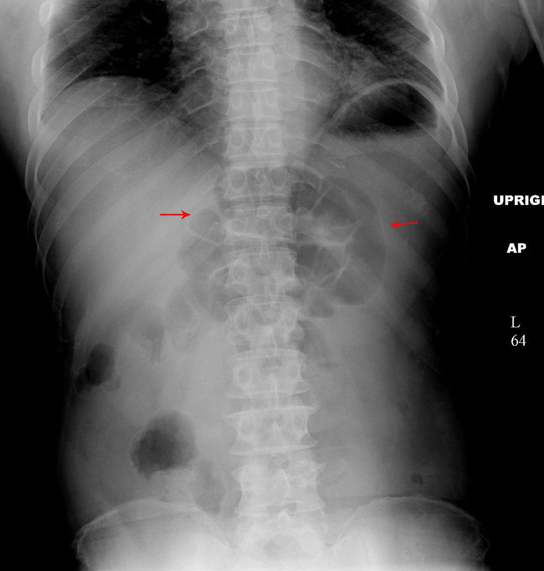 Focal Ileus