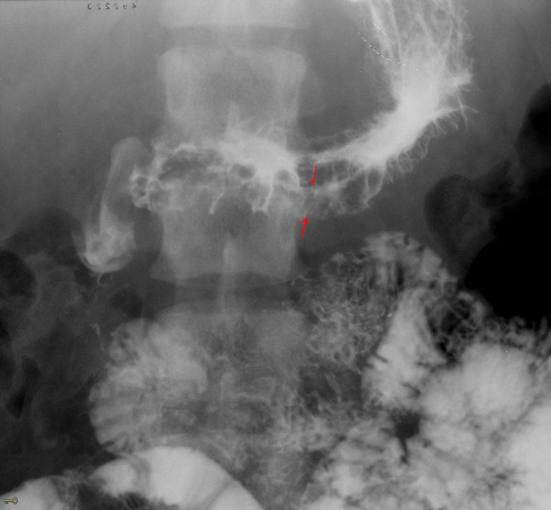 Gastric Metastases