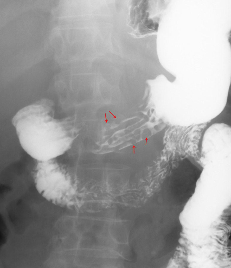 Gastric Polyps