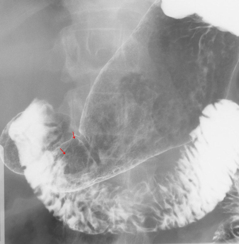 Gastric Polyps