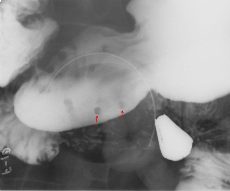 Gastric Polyps