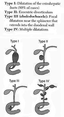 Four types of Choledocal Cysts