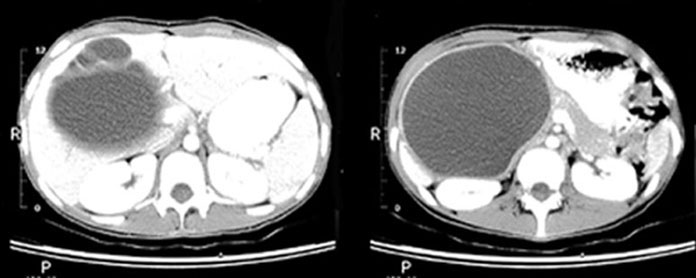Legion in common bile duct