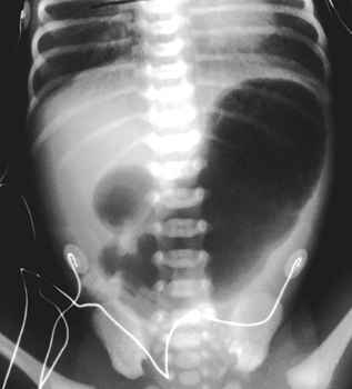 Stomach and duodenal bulb