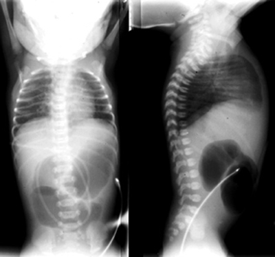 Lateral and AP view of "double bubble" sign