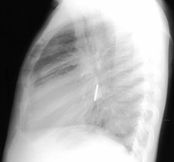 Lateral view of coin