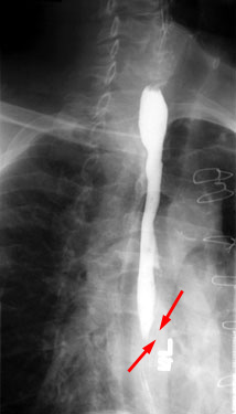 Contrast study of esophageal strictures