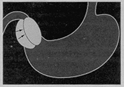 Illustation of thicken pyloric muscle