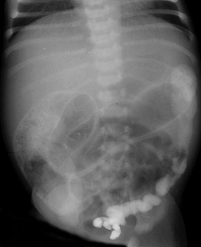 Contrast shows reduced size of rectum