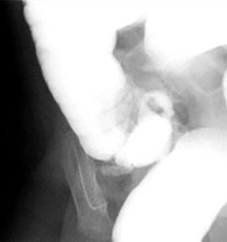 Reduced to ileocecal valve