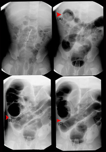 Esophageal Atresia and Tracheoesophageal Fistula