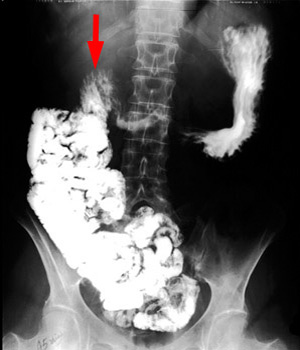 Misplaced duodenal-jejunal junction