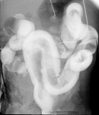 Dilated bowel loops proximal to plug