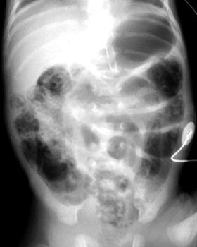 Frothy appearance of bowel 