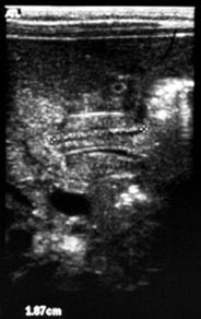 Pyloric cannal length=1.87cm