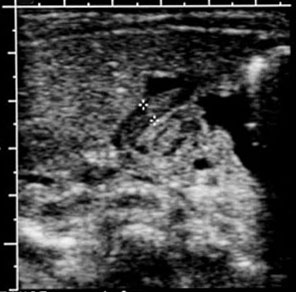 Muscle wall thickness =4.0mm