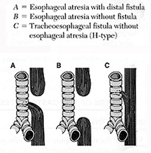 Esophageal Atresia and Tracheoesophageal Fistula
