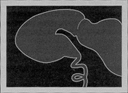 Illustration of malrotated bowel