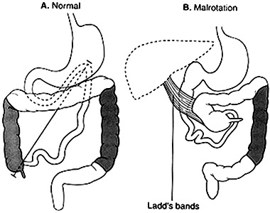 Illustration of Malrotation with Ladd's bands